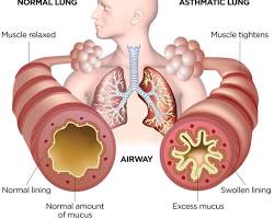 Image of Asthma lungs