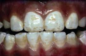 Image result for fluorosis