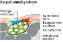 Karpaltunnelsyndrom 