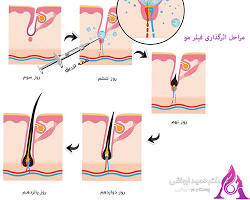 تصویر مراحل تزریق فیلر