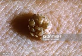 Image result for human papilloma virus