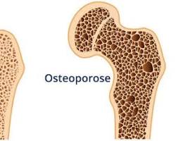 Imagem de Ossos porosos em comparação com ossos saudáveis