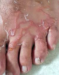 Resultado de imagen para Migración larvaria cutánea