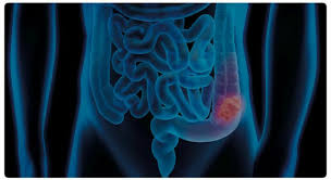 Rappresentazione medica del colon