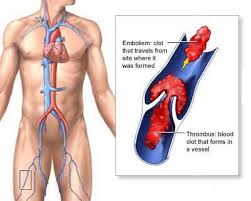 Image result for BLOOD CLOT IN THE LUNGS AND LEGS