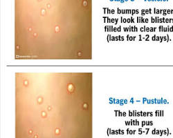 صورة Red flat spots of monkeypox