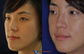 Image result for jaw surgery