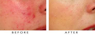 Como quitar la rosacea de la cara