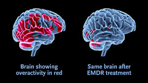 Résultat de recherche d'images pour "EMDR"