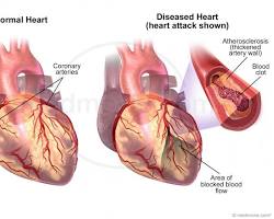 normal heart and a heart with a blocked arteryの画像