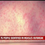  So far, more than 76 people identified exposed to Shawnee measles outbreak