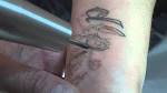 Tatuaggio tolto con laser