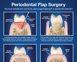 Image of Flap Surgery Procedure