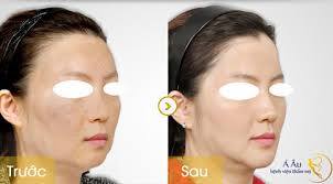 Trước và sau 2 tháng căng da trẻ hóa toàn bộ khuôn mặt bằng chỉ vàng 24k tại Bệnh viện Thẩm mỹ Á Âu. - hinh-2-jpg-5-9-201453-6973-1409889810
