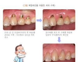 레진 치료