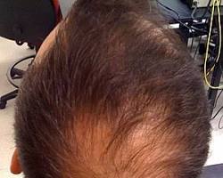 Image of person with a bald spot