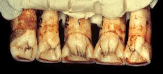 Résultat de recherche d'images pour "shovel shaped incisors"