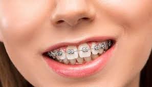 Difference between Overjet and Overbite – Sabka Dentist – Top Dental Clinic Chain In India | Best Dentists Near Me