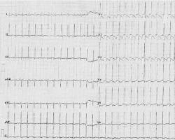 Image of Tahicardie EKG