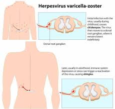 Image result for "Herpes Zoster"