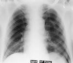 Pneumothorax