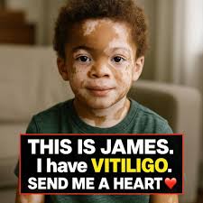Vitiligo is not a limitation, it's a reminder of diverse beauty