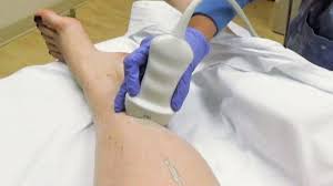 Image result for dvt