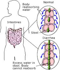 Image result for image Of Acute Watery Diarrhea