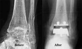 Image result for ankle replacement