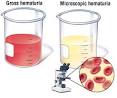 Urology Care Foundation - What is Hematuria?