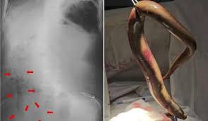 Homem é internado em estado grave após enguia entrar pelo reto e perfurar intestino