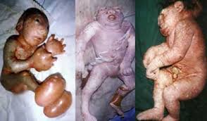 Image result for depleted+uranium+babies