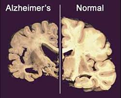 Resultado de imagen de cerebro alzheimer