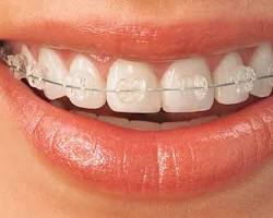 Image of Ceramic Braces