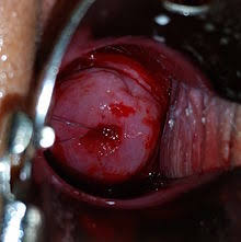 Image result for IUD image