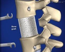 Image result for Bone Graft Substitutes