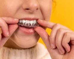 Invisalign for missing teeth