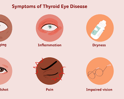 person with Thyroid Eye Disease symptoms