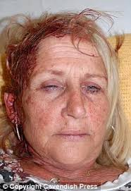 Battered: Linda Rimmer suffered serious head injuries in the attack. A businesswoman is in hiding today despite the jailing of a senior legal clerk who ... - article-0-0BC2284C000005DC-678_233x340