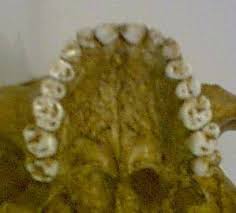 Résultat de recherche d'images pour "shovel shaped incisors"