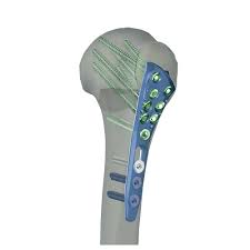 Alians Proximal Humerus Plates - CliniLab