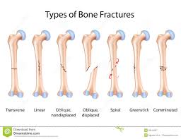 Resultado de imagen para fracturas