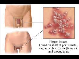 Resultado de imagen para herpes labial