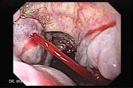 Imagini pentru esophageal varices rupture