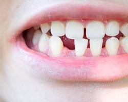 Image of Spaced Teeth