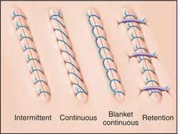 Image result for simple continuous suture pattern