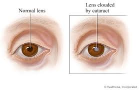 Image result for cataract images