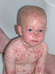 Image result for baby Chicken pox
