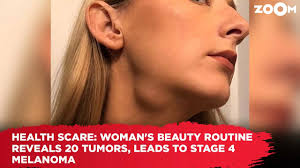 Beauty Routine Unveils 20 Tumours: A Woman's Health Scare with Stage 4 Melanoma - 1