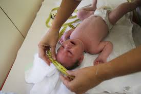 Image result for picture of BABIES WITH ZIKA VIRUS